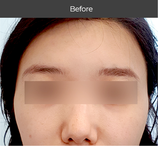 Before and after Rejuran Healer showing a visibly brighter, hydrated, and firmer complexion.