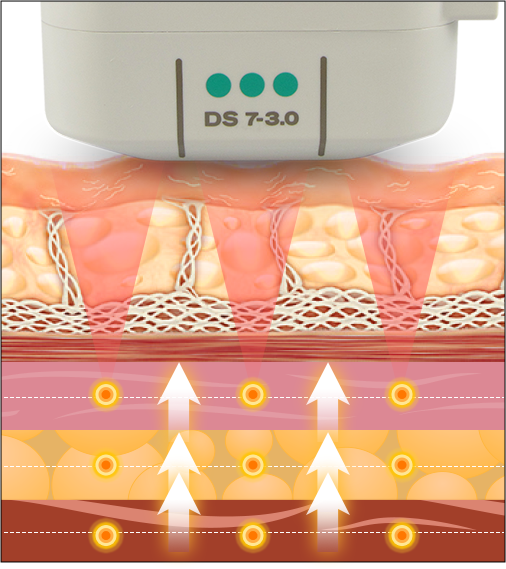 Visible Ultherapy Lifting results reducing fine lines and restoring skin elasticity.