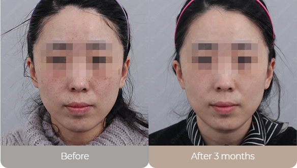 Before and after hyperpigmentation removal laser treatment, showing a significant reduction in dark spots and improved skin tone.