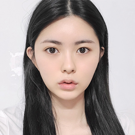 Before and after double eyelid surgery at Lienjang, achieving beautifully defined eyelids for a brighter, more youthful look.