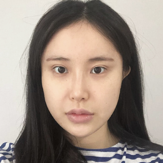 Before and after double eyelid surgery at Lienjang, achieving beautifully defined eyelids for a brighter, more youthful look.
