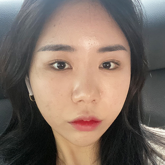 Before and after double eyelid surgery at Lienjang, achieving beautifully defined eyelids for a brighter, more youthful look.