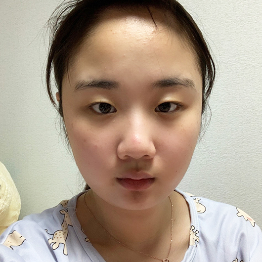 Before and after double eyelid surgery at Lienjang, achieving beautifully defined eyelids for a brighter, more youthful look.
