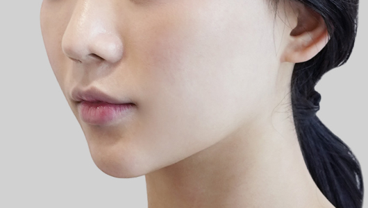 Before and after ONDA Lifting showcasing enhanced facial contours and skin firmness.