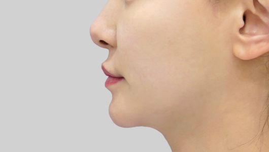 Before and after images of Titanium Lifting showing smoother and tighter skin
