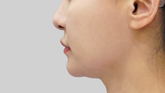 Before and after images of Titanium Lifting showing smoother and tighter skin