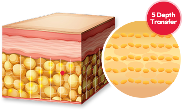 Full 5D fat grafting at Lienjang: A customized procedure targeting 5 facial layers for optimal volume restoration and long-lasting results.
