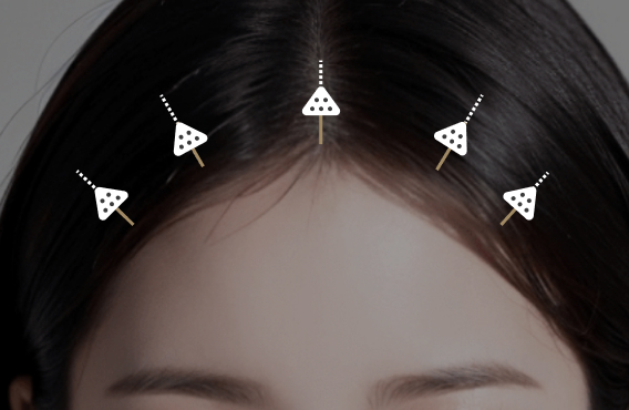 Achieve a refreshed appearance with Endotine lift surgery at Lienjang, providing natural and long-lasting results