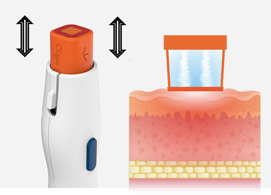 Experience the power of Oligio RF lifting technology for a youthful, sculpted appearance