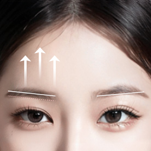 Before and after results of Endotine lift at Lienjang, enhancing facial structure with minimal scarring
