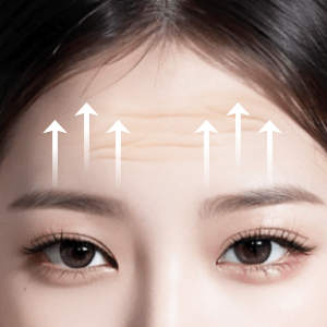 Before and after results of Endotine lift at Lienjang, enhancing facial structure with minimal scarring