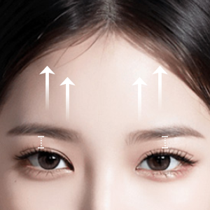 Before and after results of Endotine lift at Lienjang, enhancing facial structure with minimal scarring