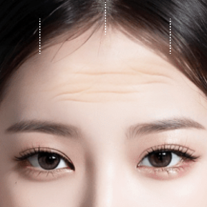 Before and after results of Endotine lift at Lienjang, enhancing facial structure with minimal scarring