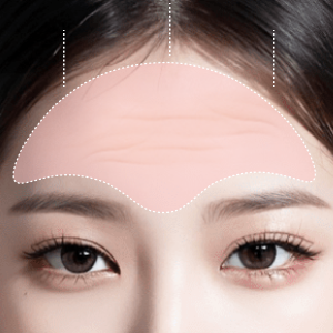 Before and after results of Endotine lift at Lienjang, enhancing facial structure with minimal scarring