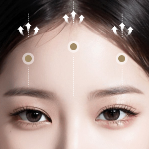 Before and after results of Endotine lift at Lienjang, enhancing facial structure with minimal scarring