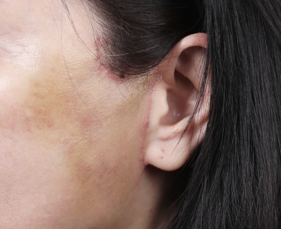 Before and after SMAS facelift results from Lienjang Plastic Surgery Center—natural facial rejuvenation with minimal downtime