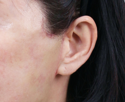 Before and after SMAS facelift results from Lienjang Plastic Surgery Center—natural facial rejuvenation with minimal downtime