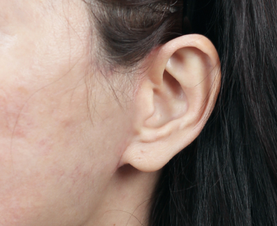 Before and after SMAS facelift results from Lienjang Plastic Surgery Center—natural facial rejuvenation with minimal downtime