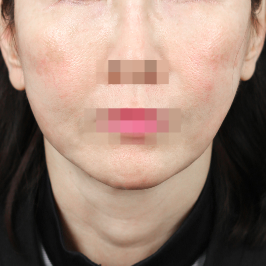 Before and after results of SMAS facelift surgery, highlighting smoother skin and youthful contours at Lienjang Plastic Surgery