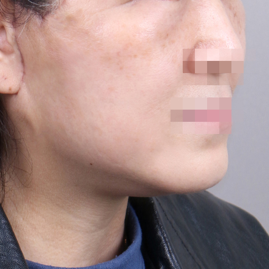 Before and after results of SMAS facelift surgery, highlighting smoother skin and youthful contours at Lienjang Plastic Surgery