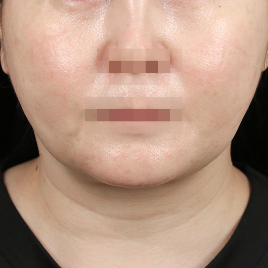 Before and after results of SMAS facelift surgery, highlighting smoother skin and youthful contours at Lienjang Plastic Surgery
