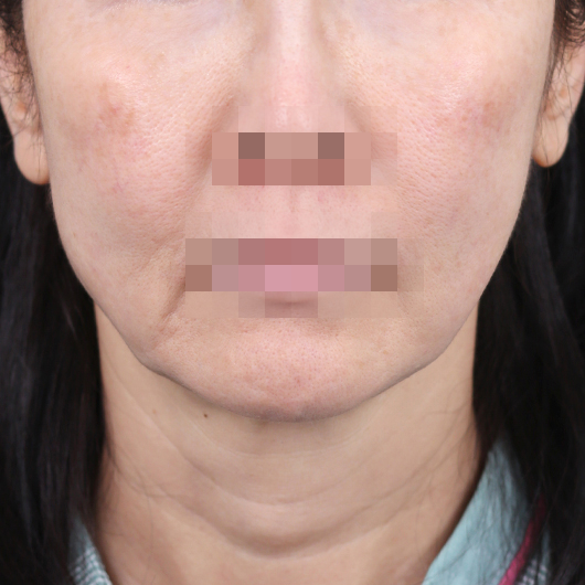 Before and after results of SMAS facelift surgery, highlighting smoother skin and youthful contours at Lienjang Plastic Surgery