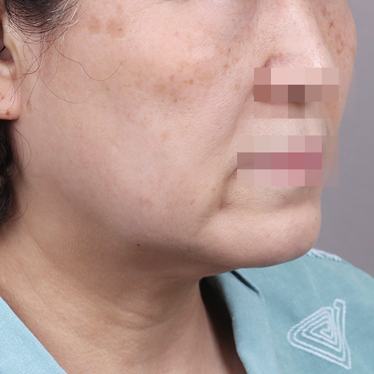 Before and after results of SMAS facelift surgery, highlighting smoother skin and youthful contours at Lienjang Plastic Surgery