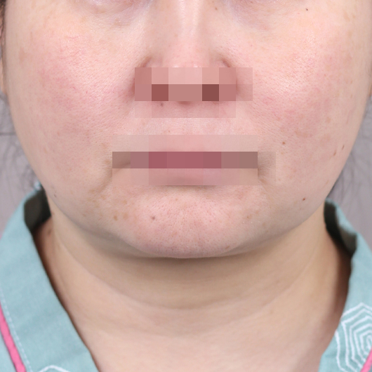 Before and after results of SMAS facelift surgery, highlighting smoother skin and youthful contours at Lienjang Plastic Surgery