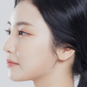 Results of mini SMAS facelift surgery at Lienjang, offering a more youthful and rejuvenated appearance with subtle enhancements