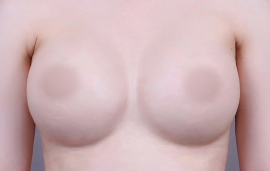 Before and after results of custom pocket breast augmentation at Lienjang, enhancing breast contours with a tailored approach for a perfect fit.