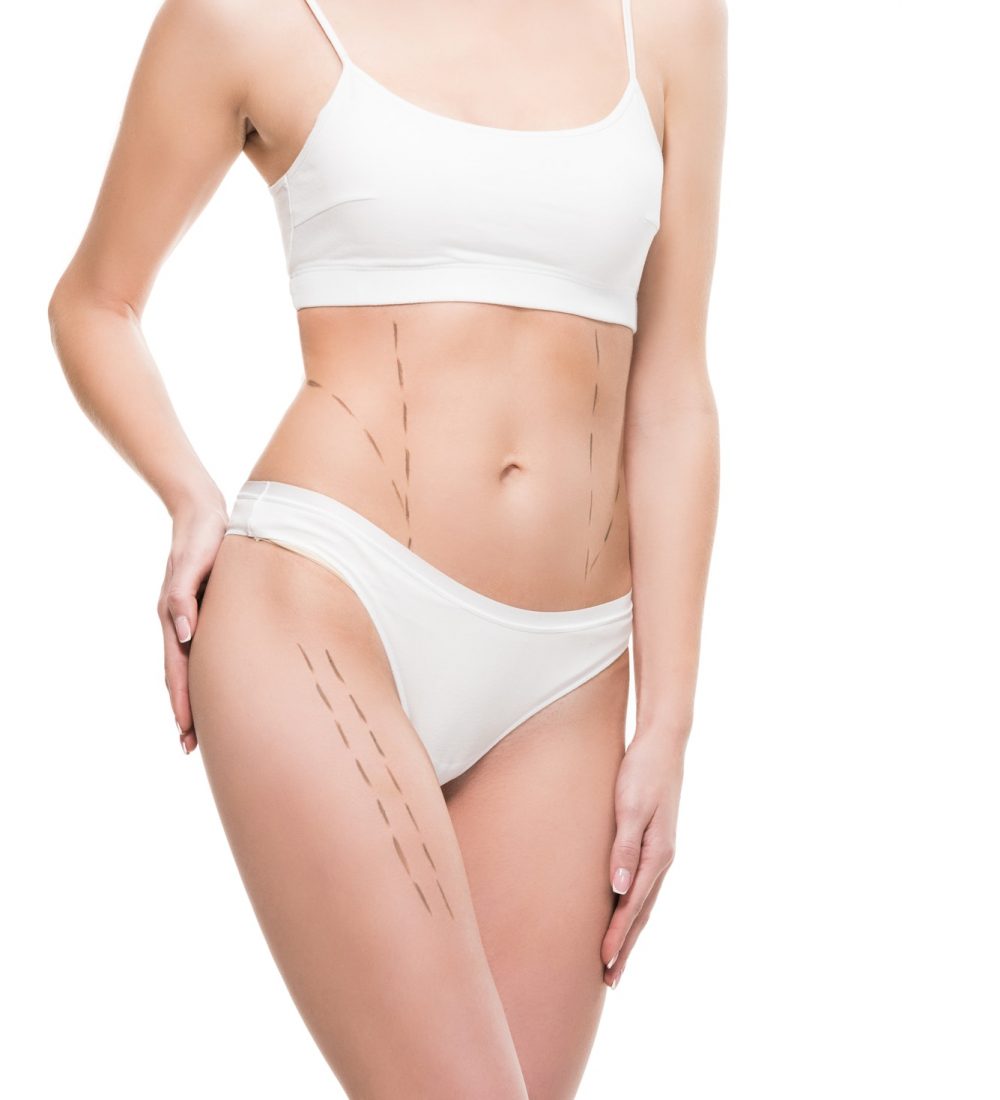 Liposuction treatment at Lienjang, effectively removing stubborn fat for a more sculpted and contoured body shape