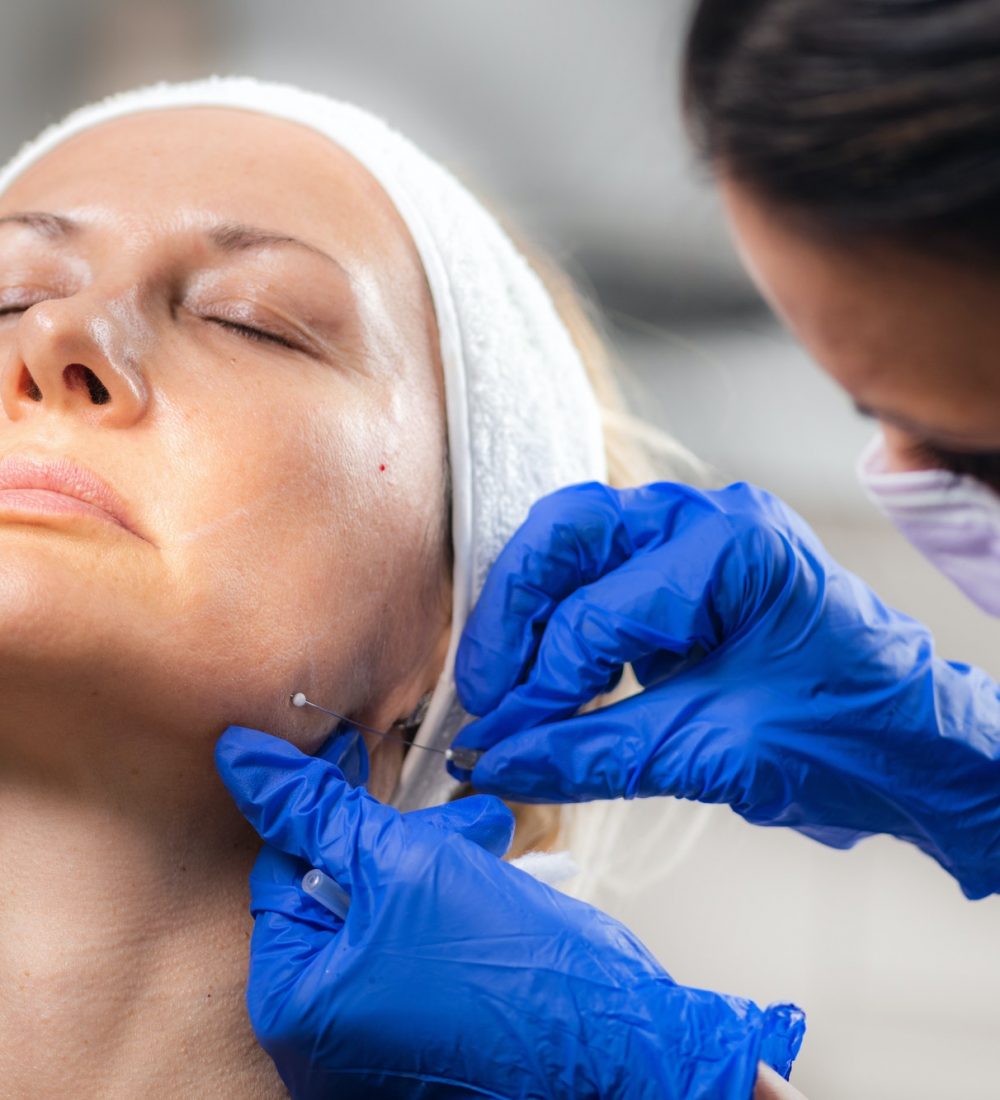 Mesotherapy Facelifting Procedure. 3D Meso Threads.